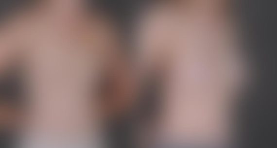 Breast Augmentation Before and After Photos in Omaha, NE, Case 8951