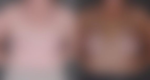 Breast Augmentation Before and After Photos in Omaha, NE, Case 8958