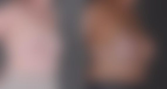 Breast Augmentation Before and After Photos in Omaha, NE, Case 8958