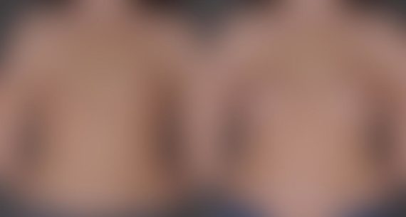 Breast Augmentation Before and After Photos in Omaha, NE, Case 8996