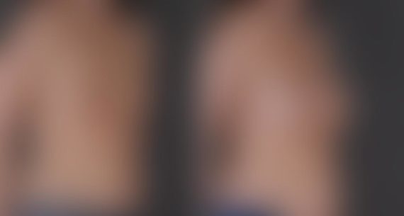 Breast Augmentation Before and After Photos in Omaha, NE, Case 8996