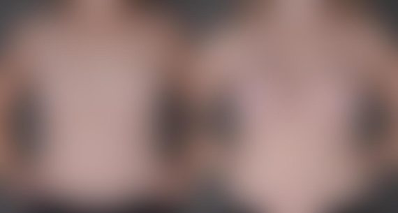 Breast Augmentation Before and After Photos in Omaha, NE, Case 9010