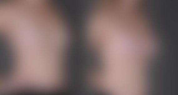 Breast Augmentation Before and After Photos in Omaha, NE, Case 9010