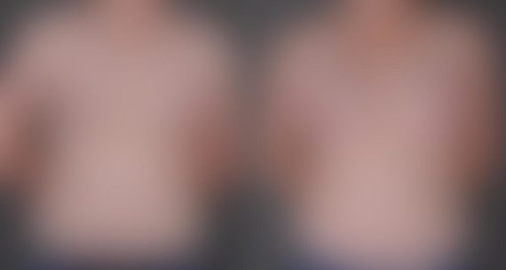 Breast Augmentation Before and After Photos in Omaha, NE, Case 9027