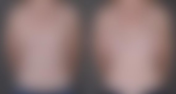 Breast Augmentation Before and After Photos in Omaha, NE, Case 9038