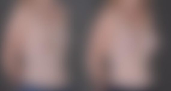 Breast Augmentation Before and After Photos in Omaha, NE, Case 9038