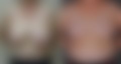 Breast Reduction Before and After Photos in Omaha, NE, Case 9049