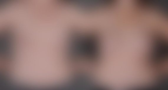 Breast Augmentation Before and After Photos in Omaha, NE, Case 9073