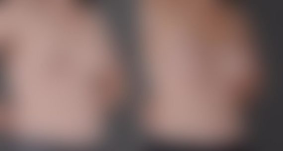 Breast Augmentation Before and After Photos in Omaha, NE, Case 9073