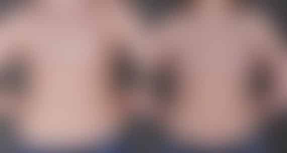 Breast Augmentation Before and After Photos in Omaha, NE, Case 9084