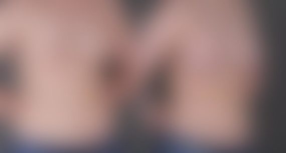 Breast Augmentation Before and After Photos in Omaha, NE, Case 9084