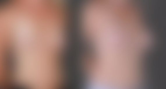 Breast Augmentation Before and After Photos in Omaha, NE, Case 9095