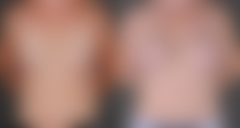 Breast Lift Before and After Photos in Omaha, NE, Case 9106