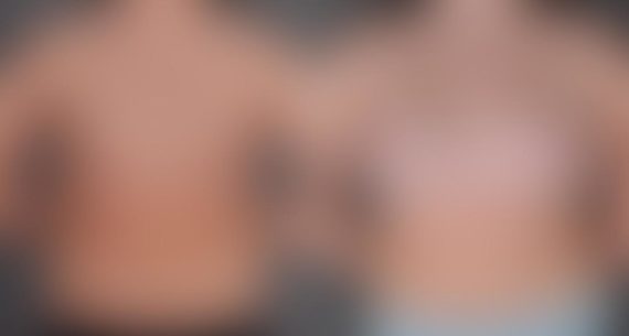 Breast Augmentation Before and After Photos in Omaha, NE, Case 9107