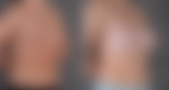 Breast Augmentation Before and After Photos in Omaha, NE, Case 9107