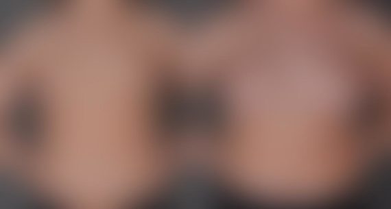 Breast Augmentation Before and After Photos in Omaha, NE, Case 9118