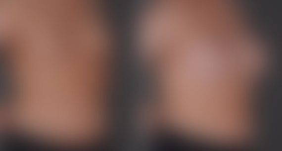 Breast Augmentation Before and After Photos in Omaha, NE, Case 9118