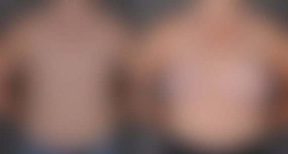 Breast Augmentation Before and After Photos in Omaha, NE, Case 9129