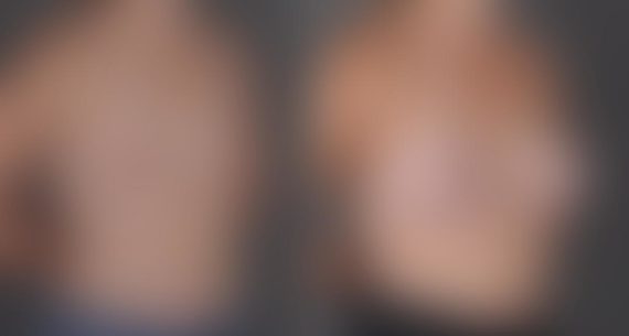 Breast Augmentation Before and After Photos in Omaha, NE, Case 9129