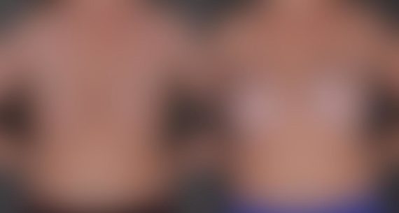 Breast Augmentation Before and After Photos in Omaha, NE, Case 9214