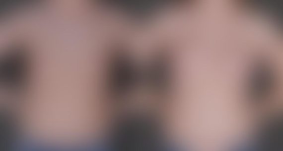 Breast Augmentation Before and After Photos in Omaha, NE, Case 9248