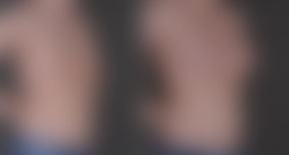 Breast Augmentation Before and After Photos in Omaha, NE, Case 9248