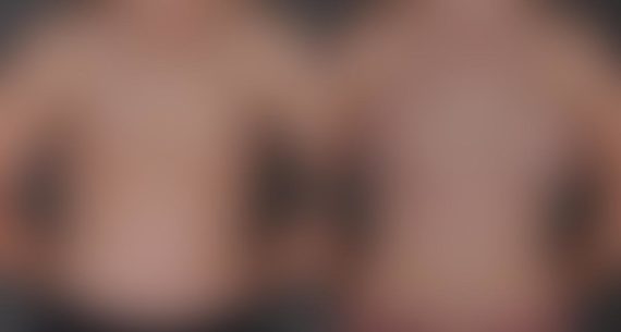 Breast Augmentation Before and After Photos in Omaha, NE, Case 9255