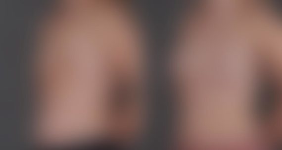 Breast Augmentation Before and After Photos in Omaha, NE, Case 9255