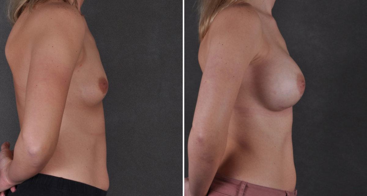 Breast Augmentation Before and After Photos in Omaha, NE, Case 9262