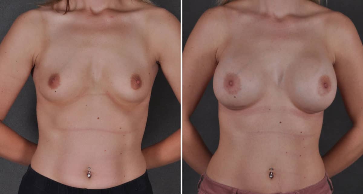 Breast Augmentation Before and After Photos in Omaha, NE, Case 9262