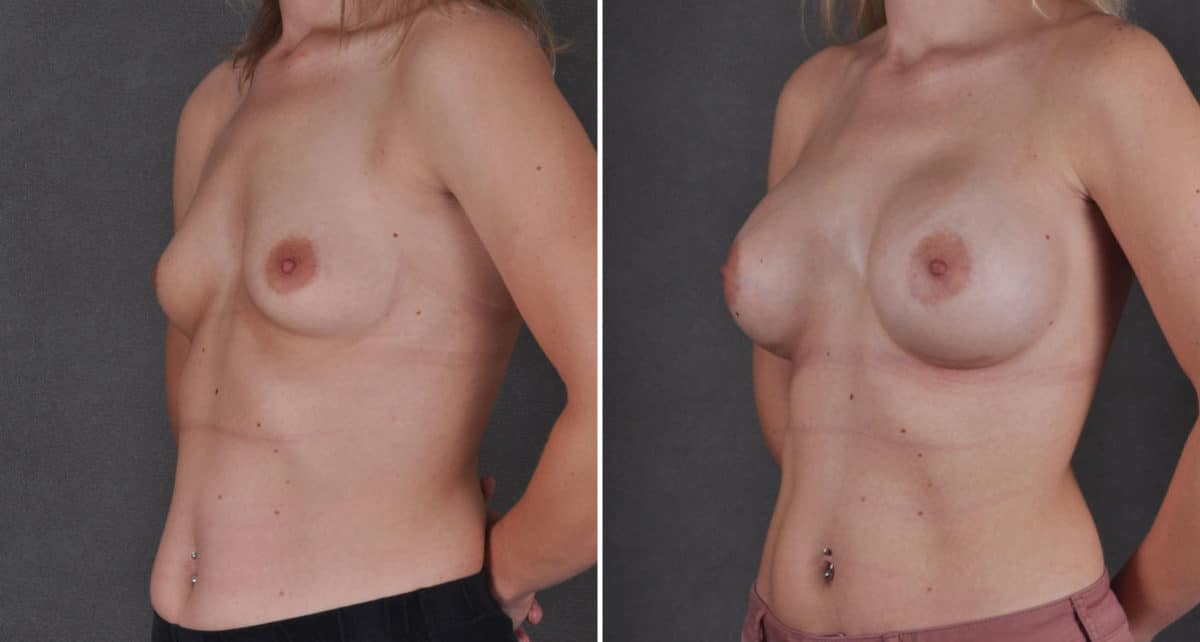 Breast Augmentation Before and After Photos in Omaha, NE, Case 9262