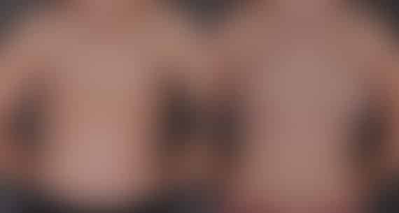 Breast Augmentation Before and After Photos in Omaha, NE, Case 9262