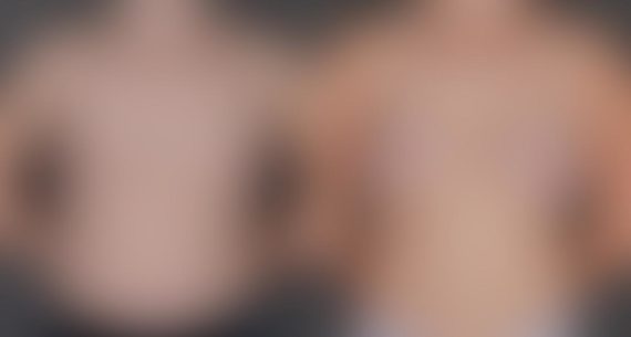Breast Augmentation Before and After Photos in Omaha, NE, Case 9301