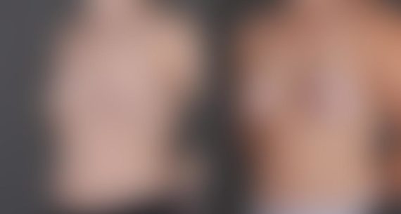 Breast Augmentation Before and After Photos in Omaha, NE, Case 9301