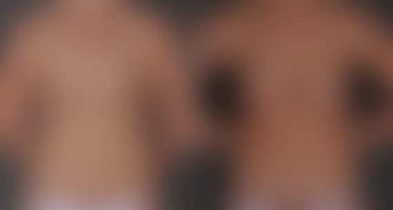 Breast Augmentation Before and After Photos in Omaha, NE, Case 9348