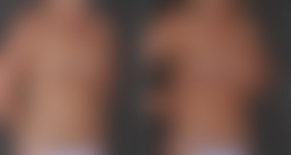 Breast Augmentation Before and After Photos in Omaha, NE, Case 9348