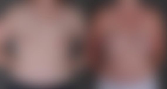 Breast Augmentation Before and After Photos in Omaha, NE, Case 9370