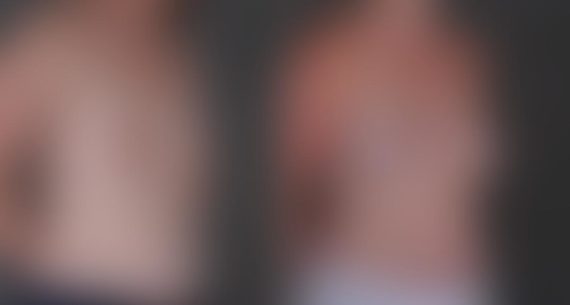 Breast Augmentation Before and After Photos in Omaha, NE, Case 9370