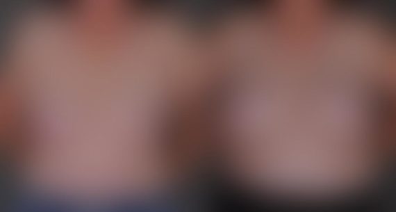 Breast Augmentation Before and After Photos in Omaha, NE, Case 9498