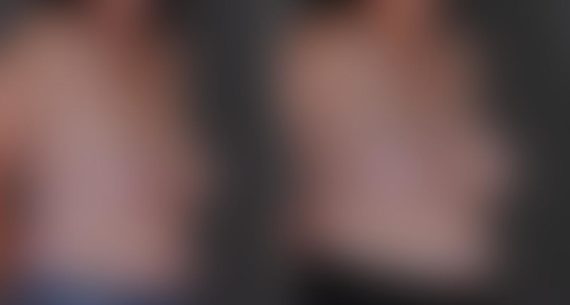 Breast Augmentation Before and After Photos in Omaha, NE, Case 9498
