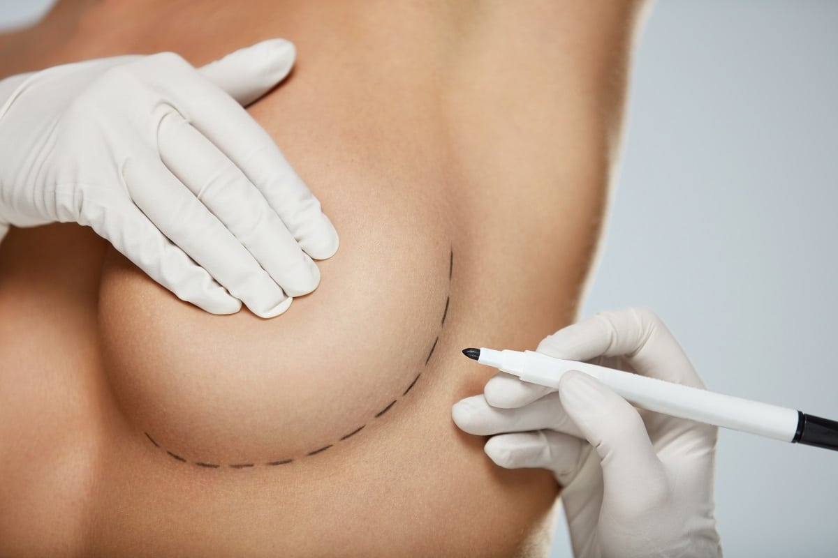 Breast augmentation with fat grafting