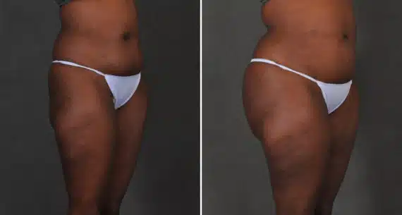 Brazilian Butt Lift Before and After Photos in Omaha, NE, Case 15898