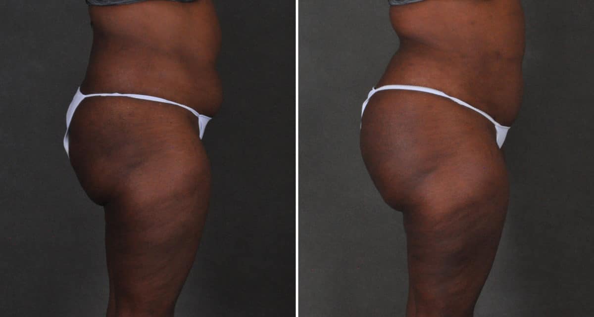 Brazilian Butt Lift Before and After Photos in Omaha, NE, Case 15898