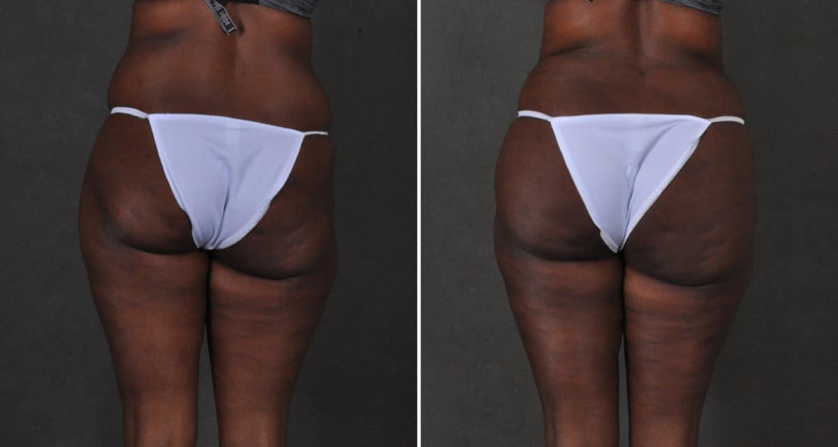 Brazilian Butt Lift Before and After Photos in Omaha, NE, Case 15898