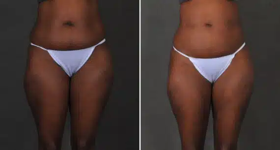 Brazilian Butt Lift Before and After Photos in Omaha, NE, Case 15898