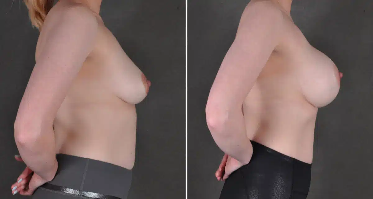 Breast Augmentation Before and After Photos in Omaha, NE, Case 15924