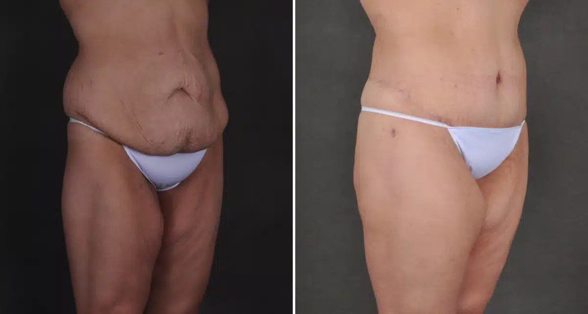 Case 15914, Tummy Tuck Before and After Photos Tummy Tuck Before and After Photos in Omaha, NE, Case 15914