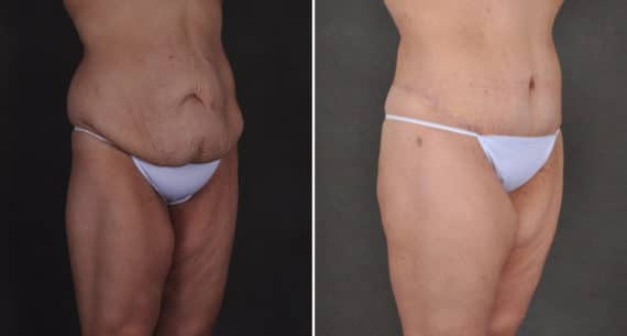 Tummy Tuck Before and After Photos in Omaha, NE, Case 15914