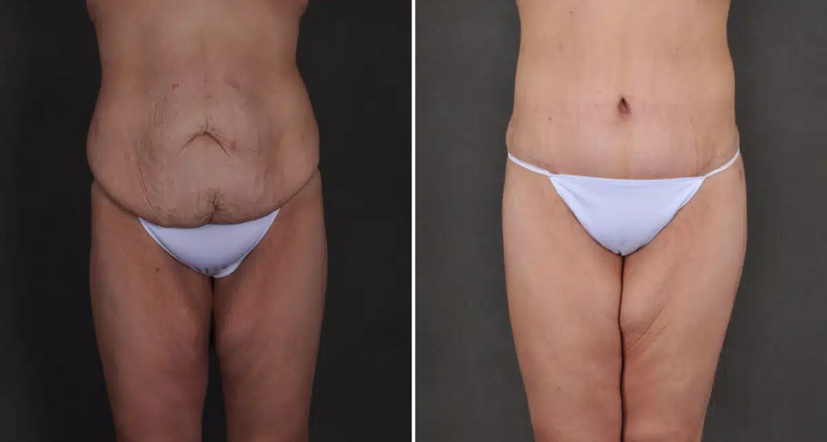 Tummy Tuck Before and After Photos in Omaha, NE, Case 15914