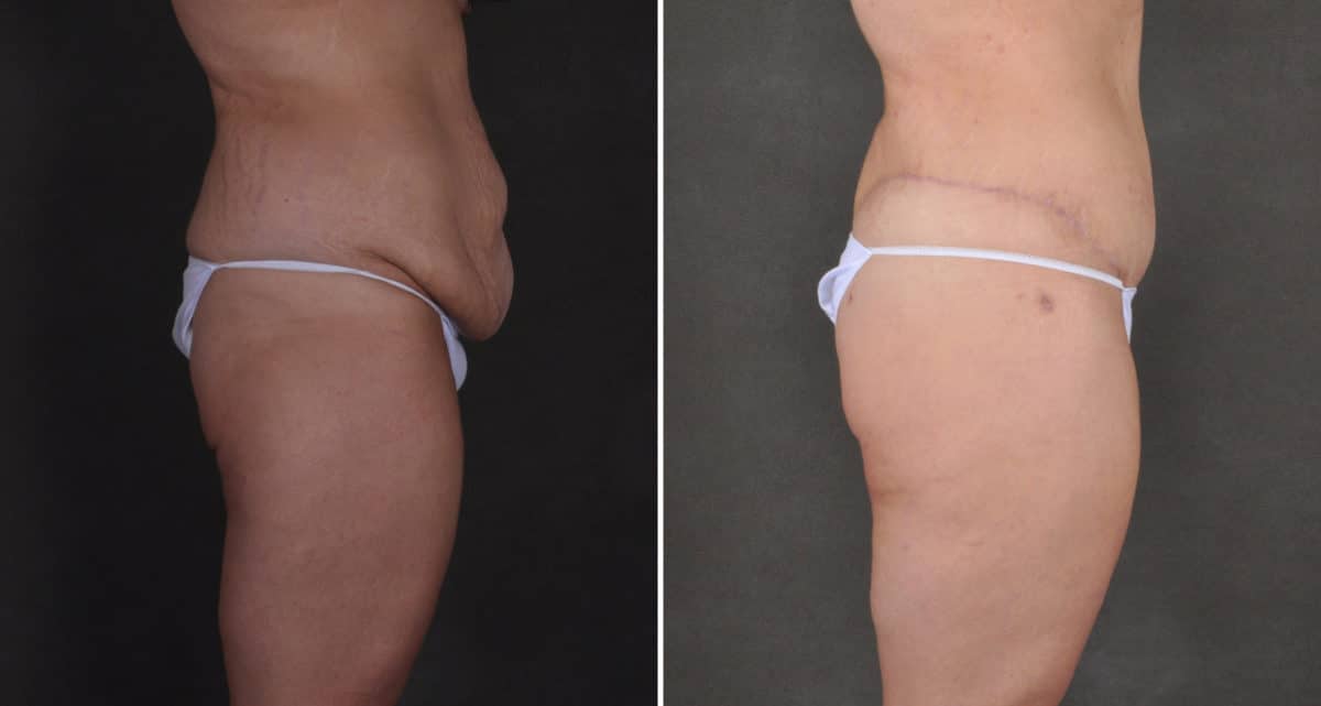 Case 15914, Tummy Tuck Before and After Photos Tummy Tuck Before and After Photos in Omaha, NE, Case 15914